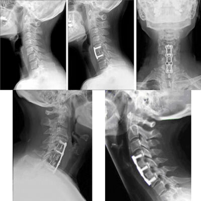 Spine Anterior Cervical Plate Titanium Cervical Plate Implant ...